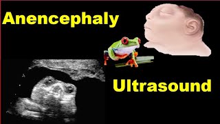 Anencephaly Ultrasound [upl. by Ahsiatal988]