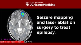 Stopping Seizures Seizure Mapping and Laser Ablation Surgery for Epilepsy [upl. by Euphemie]