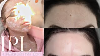 IPL The Facial that changed my skin [upl. by Suchta928]