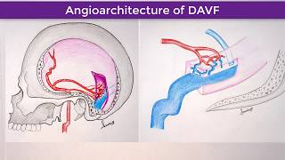 Right TransverseSigmoid Sinus Dural Arteriovenous Fistula [upl. by Omixam469]