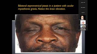 Approach to patient with diplopia [upl. by Yelrebma249]