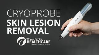 CryoProbe  No Pain Skin Lesion Removal [upl. by Melone]