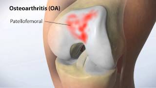 MAKOplasty Partial Knee Resurfacing [upl. by Fin]