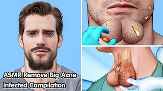 ASMR Remove Big acne Dogtick Infected Compilation  Deep Cleaning Animation [upl. by Geerts529]