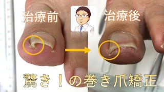 巻き爪  ネイルエイド治療例【片側の変形が強い症例】 自分でできる矯正 手術せずに痛みを改善corrective ingrown toenails by Nailaid  case report [upl. by Genia]