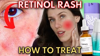 Do You Have A Retinol Rash Or Are You Experiencing Retinization [upl. by Julietta]