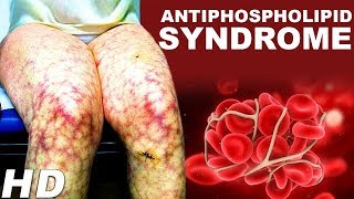 Antiphospholipid Antibody Syndrome An Autoimmune Disease  Antiphospholipid Treatments And Symptoms [upl. by Patten887]