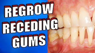 What Causes RECEDING GUMS  How to Reverse RECEDING GUMS Naturally [upl. by Conard]