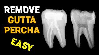 Gutta percha removal  Endodontic retreatment [upl. by Dewie751]