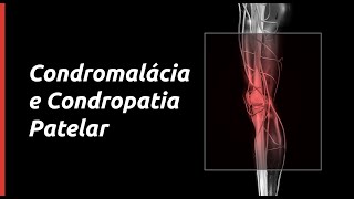 Saiba tudo sobre Condromalácia e condropatia patelar [upl. by Trembly361]