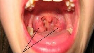 tonsillitis and homeopathic medicine [upl. by Nahshun]