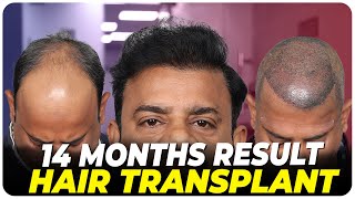 Hair Transplant in Vizag  Best Results amp Cost of Hair Transplant in Vizag [upl. by Son]