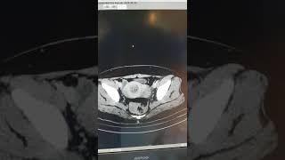 Ovarian Dermoid cyst llultrasound usg [upl. by Rickert635]