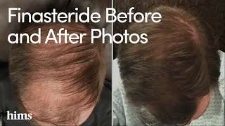 Finasteride Results Finasteride Before and After Photos [upl. by Jessalin948]