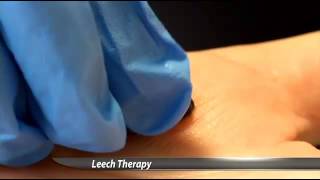 Hospital Uses Leeches to Heal Patients [upl. by Battista]