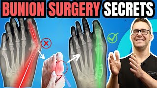 Bunion Surgery SECRETS amp FAST Recovery Bunionectomy vs Lapiplasty [upl. by Peggy]