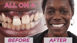 AllOnImplant Dental Implants Before amp After Missing Teeth Smile Transformations  Dental Boutique [upl. by Bergeman]