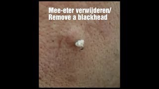 Grote meeeter verwijderen  Remove a big blackhead [upl. by Ecadnak837]