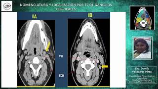 Localización y nomenclatura de las cadenas ganglionares cervicales mediante TC [upl. by Lecram]