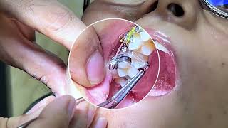 All You Need to Know About Rotation in Orthodontics 🤯🤯  Orthodontic Biomechanics [upl. by Wiltz]