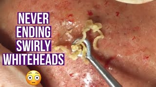 Blackhead and whitehead extractions relaxing amp satisfying [upl. by Rilda958]