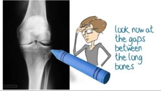 How to interpret knee Xrays  Part 1  AP view [upl. by Econah]