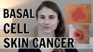 BASAL CELL SKIN CANCER WHAT YOU SHOULD KNOW DR DRAY [upl. by Amek299]