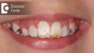 How do you treat Dental Fluorosis  Dr Aniruddha KB [upl. by Goodrow695]