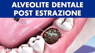 ALVEOLITE DENTALE post estrazione del dente  Cause e trattamento © [upl. by Rekoob]