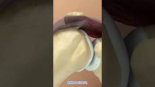 견봉하 점액낭염과 충돌 증후군 어깨 통증의 이해와 관리 Subacromial Bursitis amp Impingement Understanding Shoulder Pain [upl. by Kaleb]