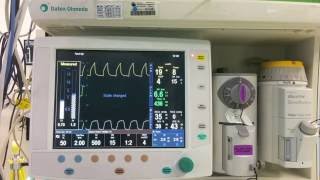 recruitment with S5 avance anesthesia machine [upl. by Nannah]