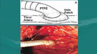 Surgical Approaches for Peripheral Arterial Disease PAD [upl. by Adiaros]