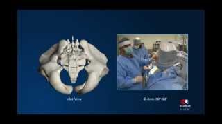 SILOK® Sacroiliac Joint Fixation System [upl. by Ayaet]