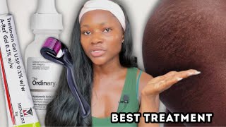 The best treatment for stretch marks ever  How to clear stretch marks fast at home stretchmarks [upl. by Whitelaw829]