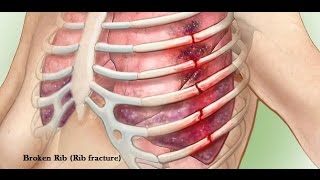 Rib fractures and rib belts [upl. by Rawna890]