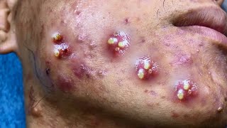 Big Cystic Acne Blackheads Extraction Blackheads amp Milia Whiteheads Removal Pimple Popping [upl. by Bobbette]