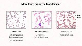 Anemia Lesson 4  Clues from the blood smear [upl. by Atneuqal]