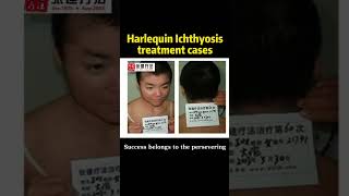 How has the harlequin ichthyosis been treated ichthyosis dryskin ichthyosisvulgaris fishskin [upl. by Carie]