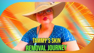 The Harsh Reality of Excess Skin Tammy Slatons Weight Loss Journey and the Challenges Ahead [upl. by Dorrahs945]