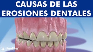 Abfracción atrición abrasión reabsorción dental y otros problemas de desgaste de los dientes © [upl. by Airrej736]