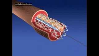 coronary artery stenting [upl. by Aiekahs]