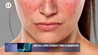 ¿Qué es y cómo se manifiesta el lupus cutáneo [upl. by Anirbed]