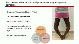 Blounts Disease part 2 Surgical Technique  Tips amp Tricks J Fernandes [upl. by Wellesley]