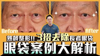 眼袋案例大解析！熟齡整形！3招去除長者眼袋｜周杰醫師 [upl. by Rehpotsihrc218]