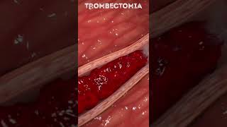 Thrombocythemia also known as essential thrombocythemia Thrombocythemia EssentialThrombocythemia [upl. by Nyrahtak949]