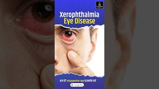 Vitamin A deficiency  xerophthalmia  Ophthalmology ophthalmology xerophthalmia VitaminA [upl. by Anayad239]