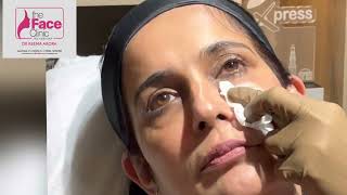 Profhilo Treatment Live  Dr Reema Arora  The Face Clinic  South Delhi [upl. by Seabrook]