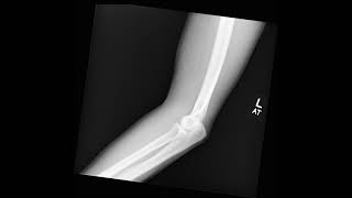 Elbow XRay in Motion [upl. by Beesley]