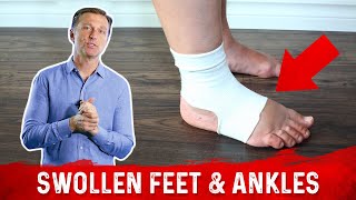 Foods for Fluid Retention in the Feet and Ankles – DrBerg [upl. by Estelle]