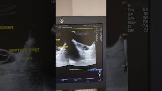 Serous vs mucinous cystadenoma left ovary Left ovarian septate cyst ultrasound and color Doppler [upl. by Paynter]